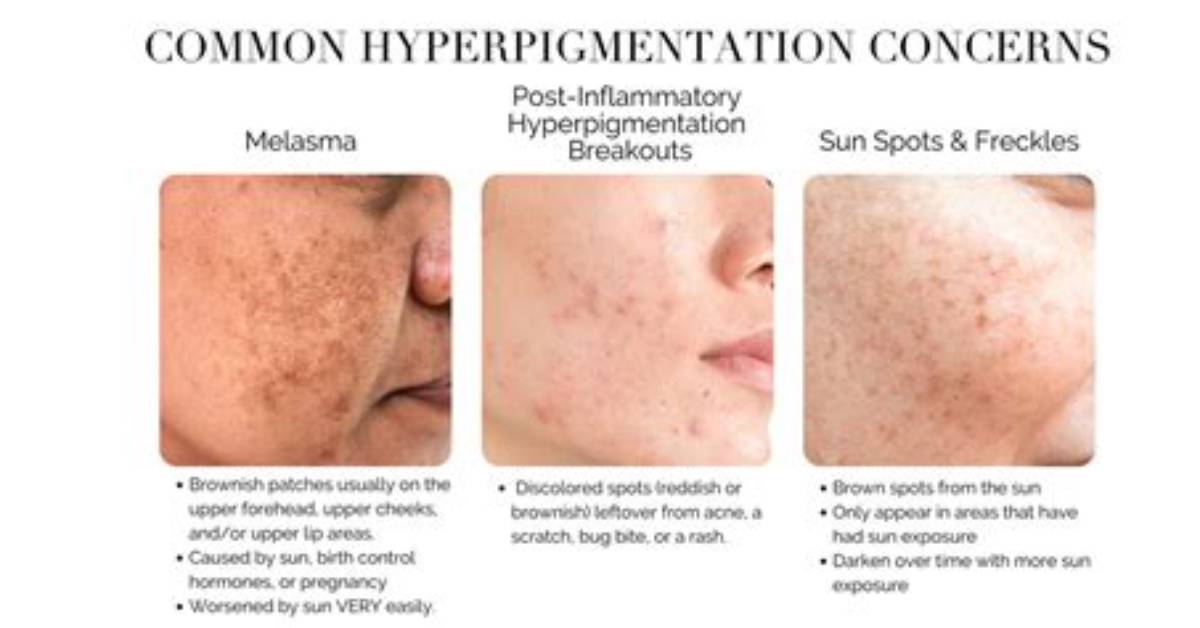 When Does Hyperpigmentation Go Away?
