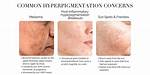 When Does Hyperpigmentation Go Away?