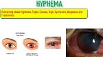 When Does Hyphema Go Away?