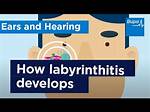 When Does Labyrinthitis Go Away?