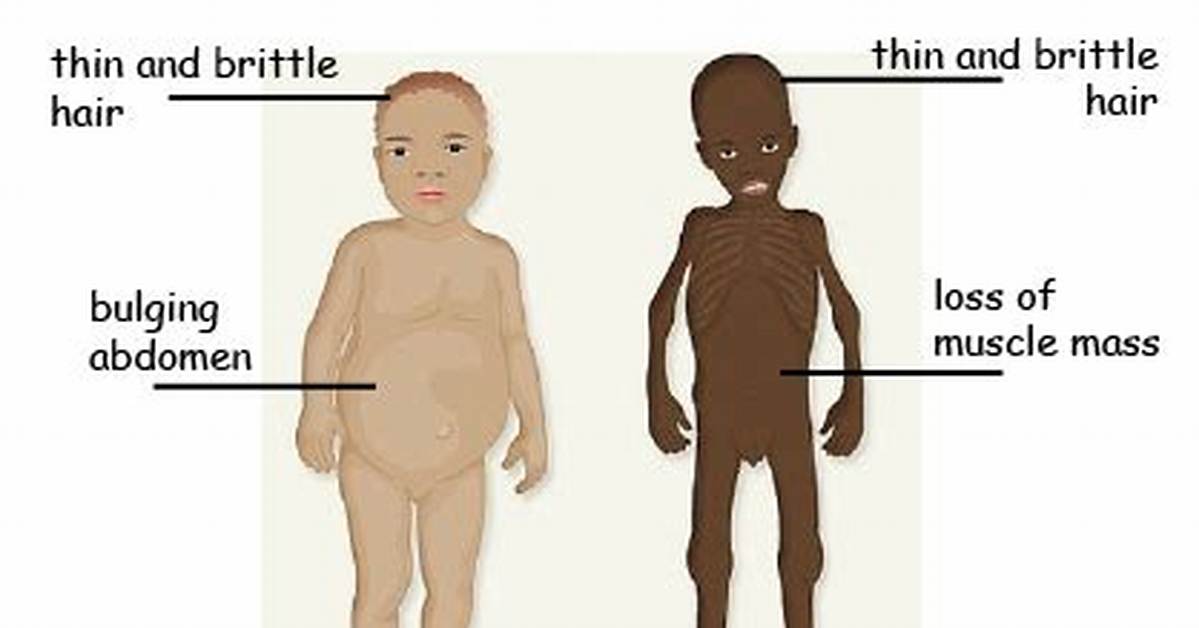 When Does Malnourished Mean?