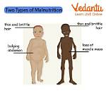 When Does Malnourished Mean?