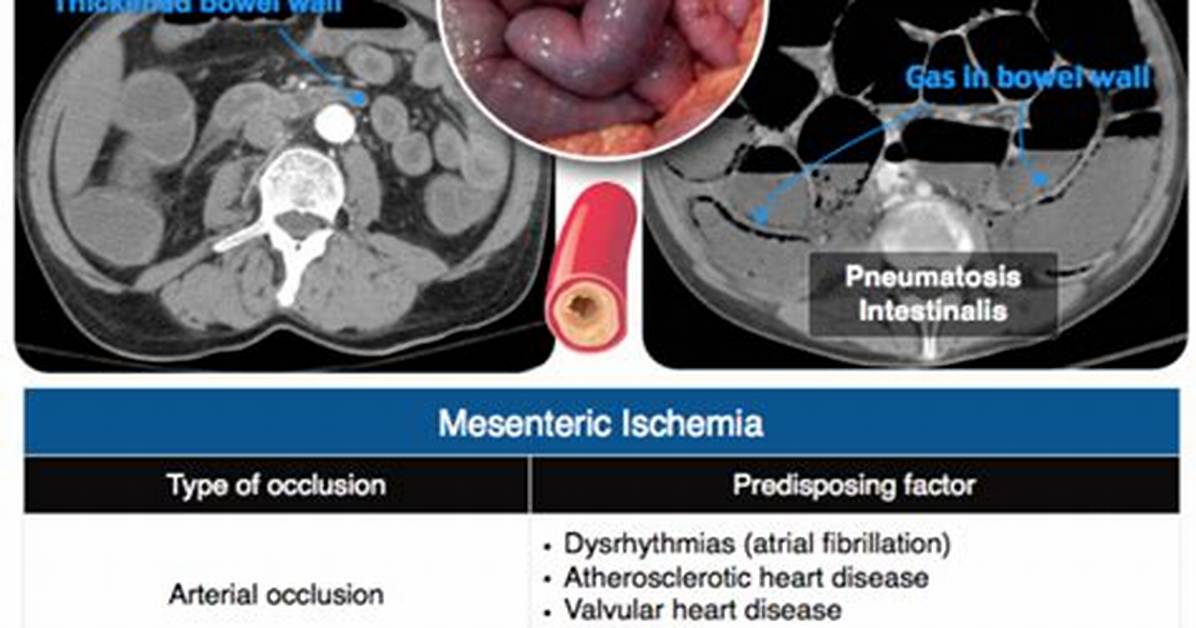 When Does Mesenteric Ischemia Occur?