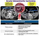When Does Mesenteric Ischemia Occur?
