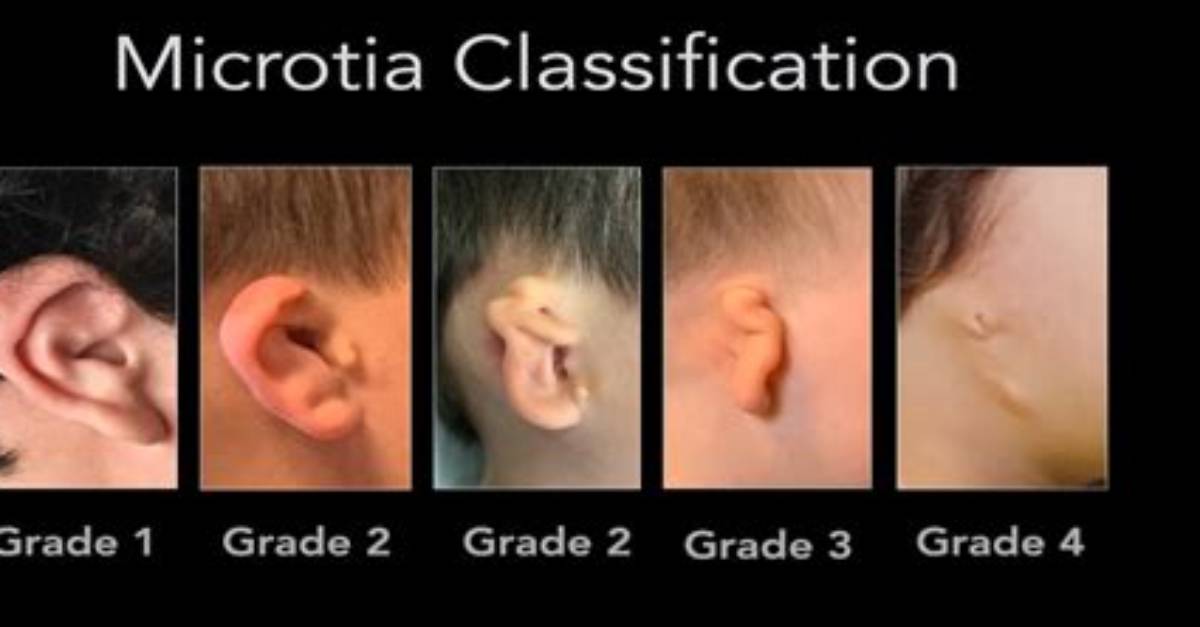 When Does Microtia Occur?