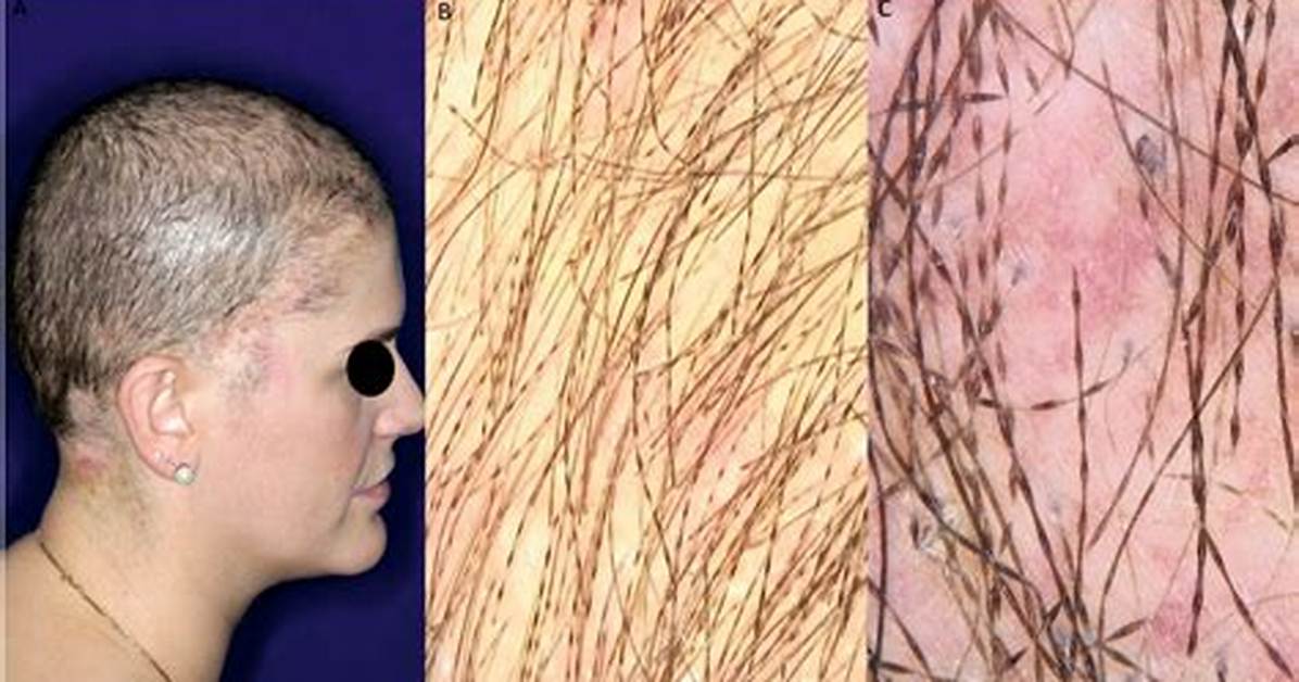 When Does Monilethrix Occur?