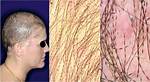 When Does Monilethrix Occur?