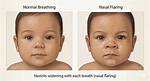 When Does Nasal Flaring Occur?