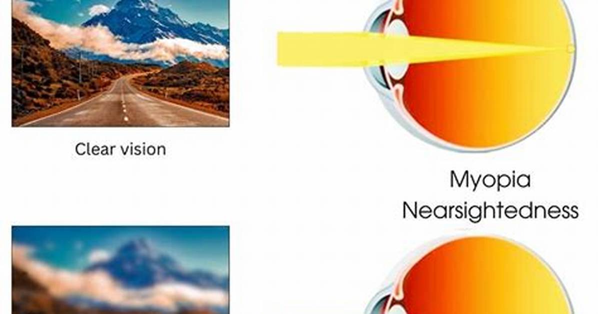 When Does Nearsightedness Stop?