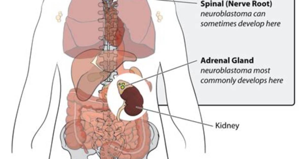 When Does Neuroblastoma Start?