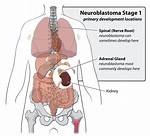 When Does Neuroblastoma Start?