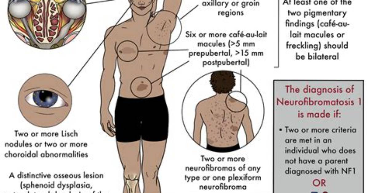 When Does Neurofibromatosis Develop?