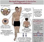 When Does Neurofibromatosis Develop?