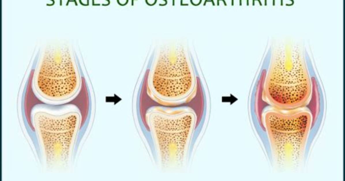 When Does Osteoarthritis Start?