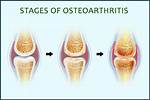 When Does Osteoarthritis Start?