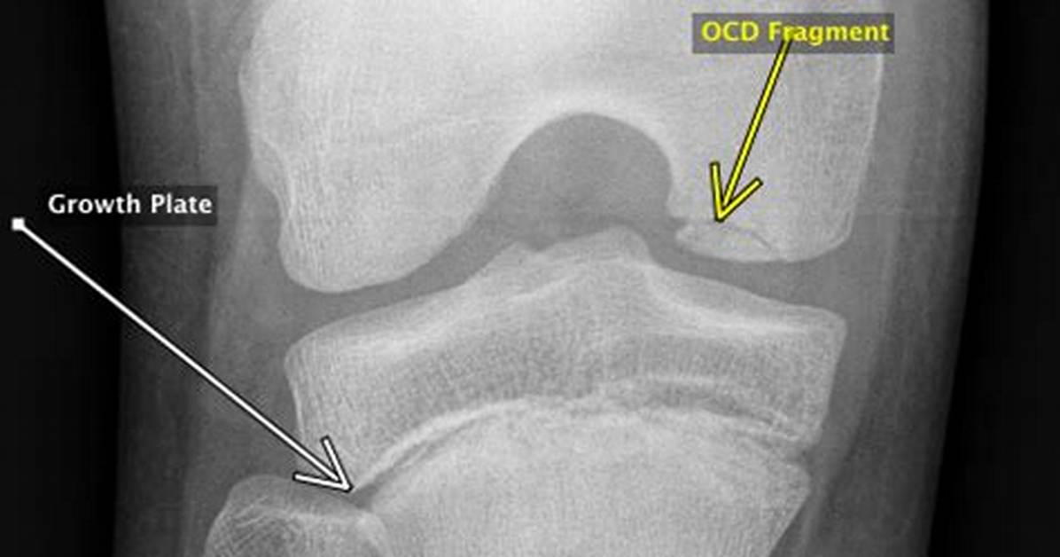 When Does Osteochondritis Dissecans Develop?
