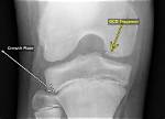 When Does Osteochondritis Dissecans Develop?