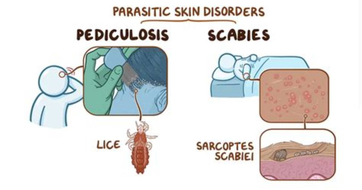 When Does Pediculosis Start?