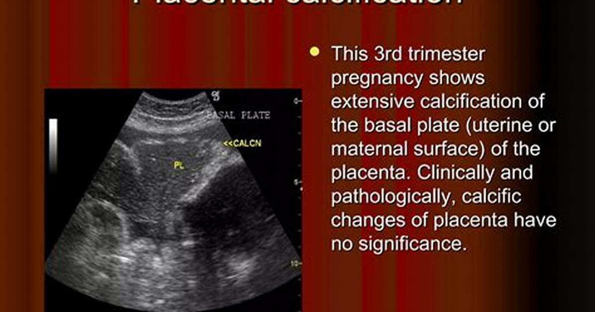 When Does Placenta Start Calcifying?