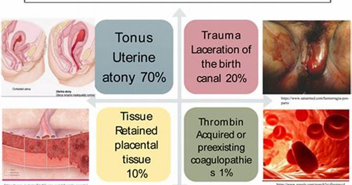 When Does Pph Occur?