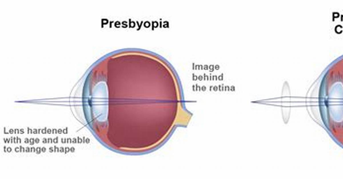 When Does Presbyopia Start?