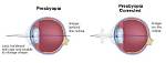 When Does Presbyopia Start?