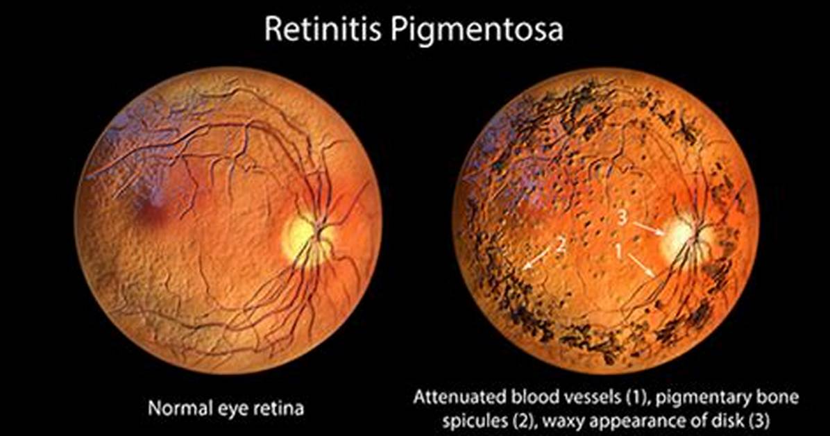 When Does Retinitis Pigmentosa Develop?