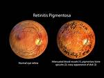 When Does Retinitis Pigmentosa Develop?