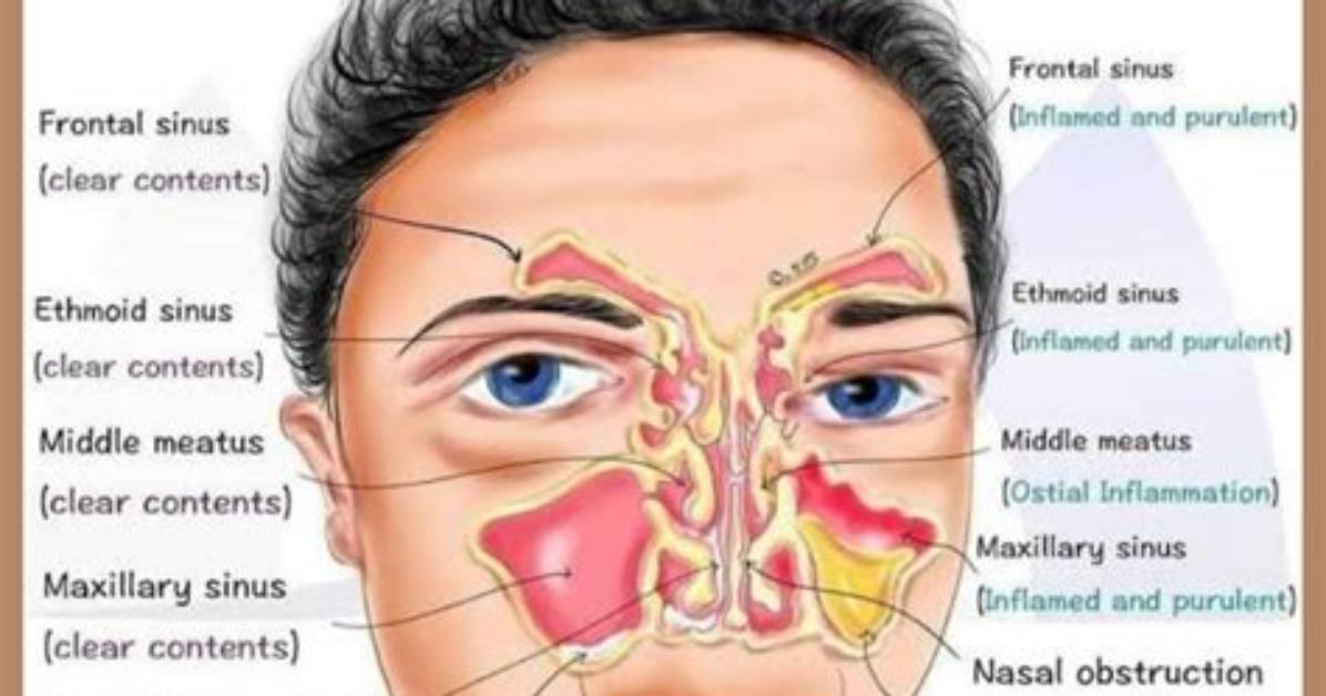 When Does Rhinitis Go Away?