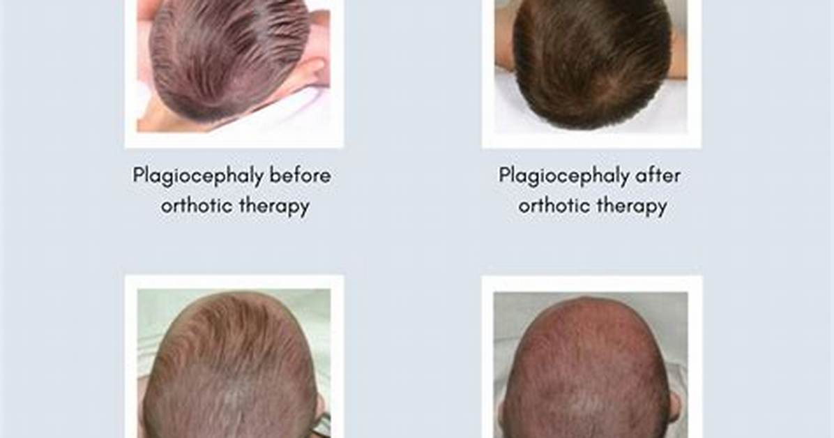 When Does Risk of Plagiocephaly Decrease?