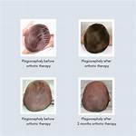 When Does Risk of Plagiocephaly Decrease?