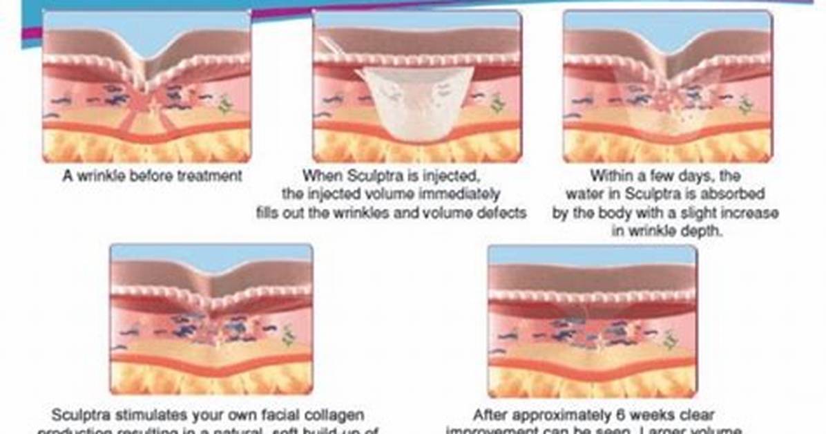 When Does Sculptra Start Working?