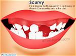 When Does Scurvy Occur?