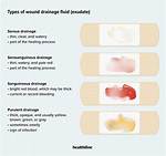 When Does Serous Drainage Stop?