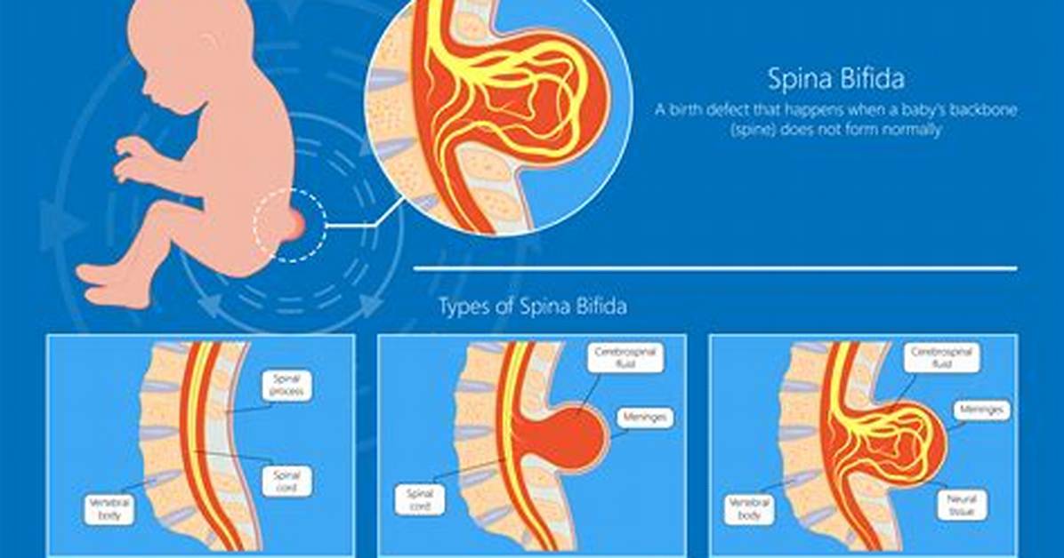When Does Spina Bifida Develop?