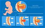 When Does Spina Bifida Develop?