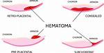 When Does Subchorionic Hematoma Happen?
