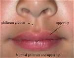 When Does the Philtrum Develop?