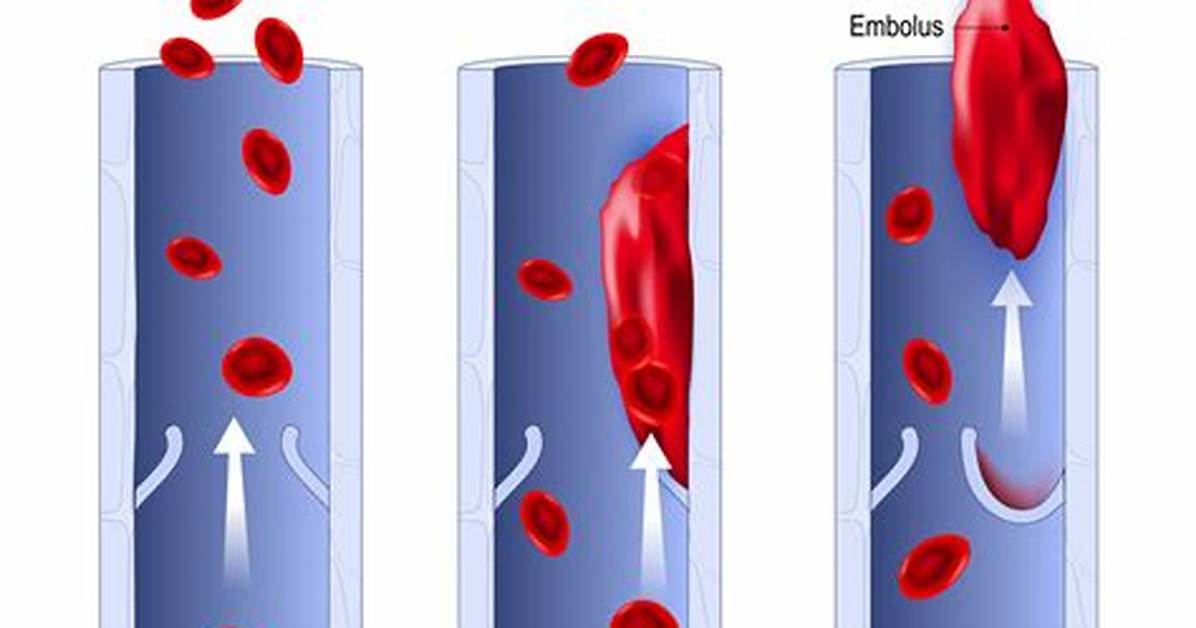 When Does Thrombosis Occur?