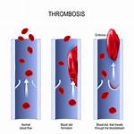 When Does Thrombosis Occur?