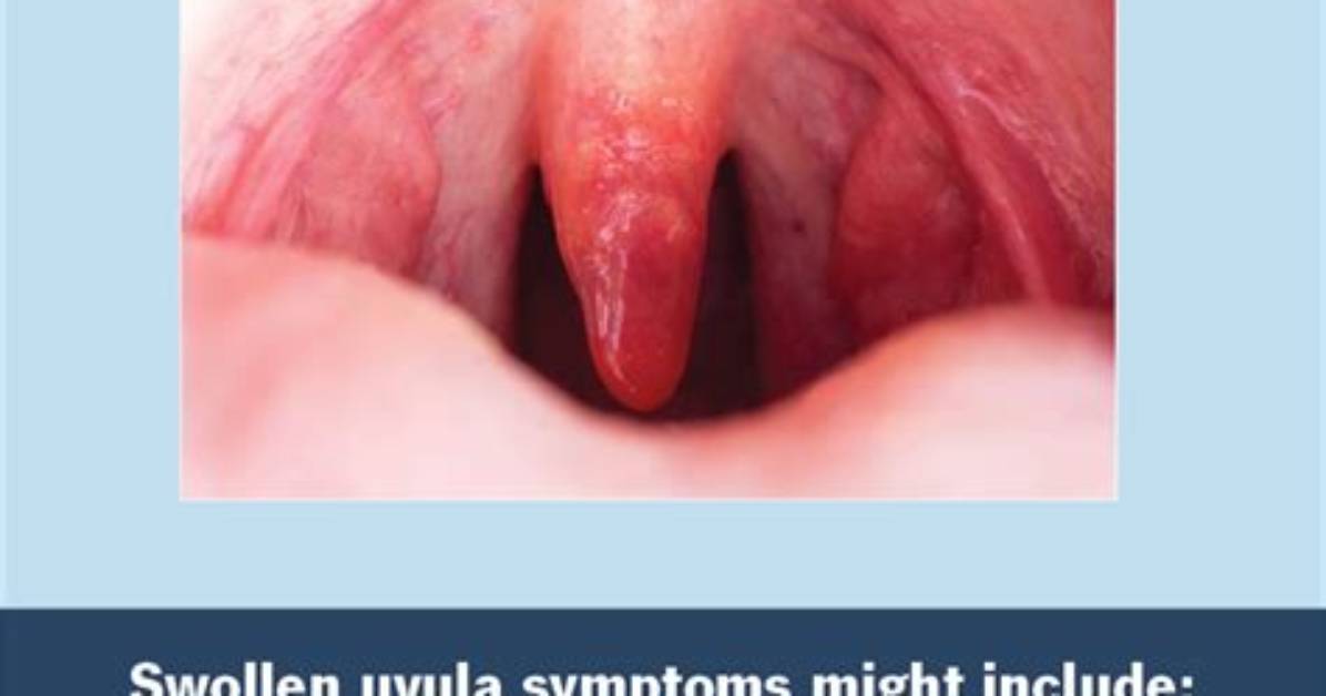 When Does Uvulitis Go Away?