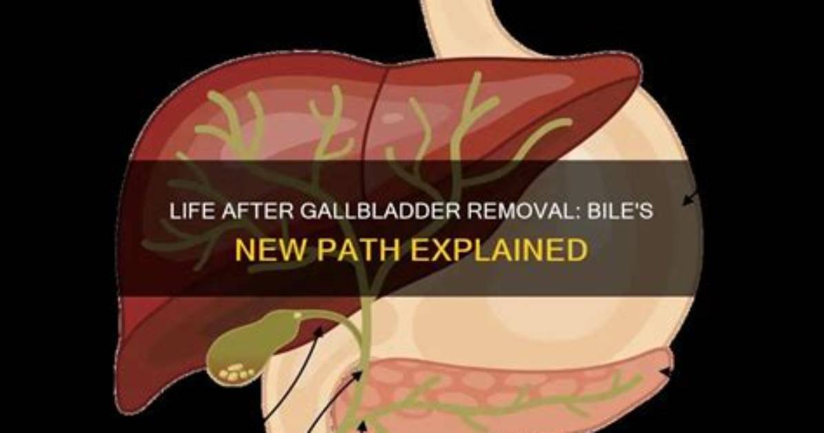 When Gallbladder Is Removed?
