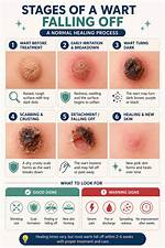 When Is a Wart Dead?