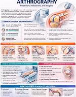 When Is Arthrography Done?