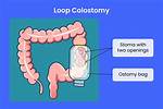 When Is Colostomy Indicated?