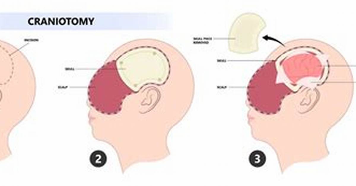 When Is Craniotomy Done?