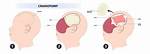 When Is Craniotomy Done?