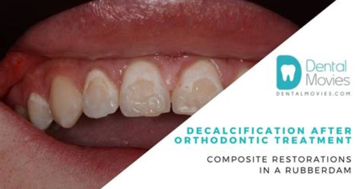 When Is Decalcification Done?