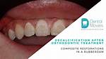 When Is Decalcification Done?