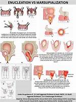 When Is Enucleation Necessary?